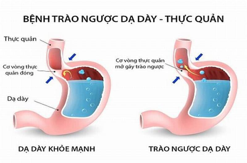 Tìm hiểu về bệnh trào ngược dạ dày thực quản