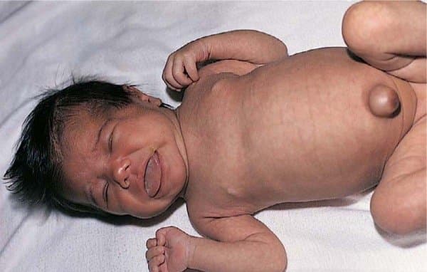 Suy giáp bẩm sinh nguy hiểm như thế nào?