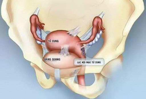 U nang buồng trứng dạng lạc nội mạc tử cung là gì?