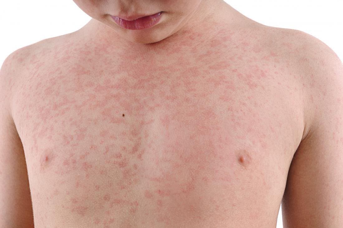 Bệnh sởi có lây không - Những biến chứng nguy hiểm