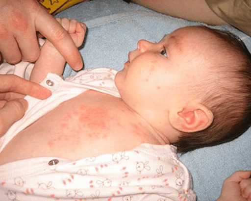 Bệnh sởi - Nguyên nhân - triệu chứng và cách phòng tránh