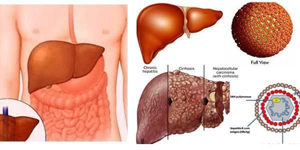 Biểu hiện xơ gan cổ trướng và cách điều trị hiệu quả
