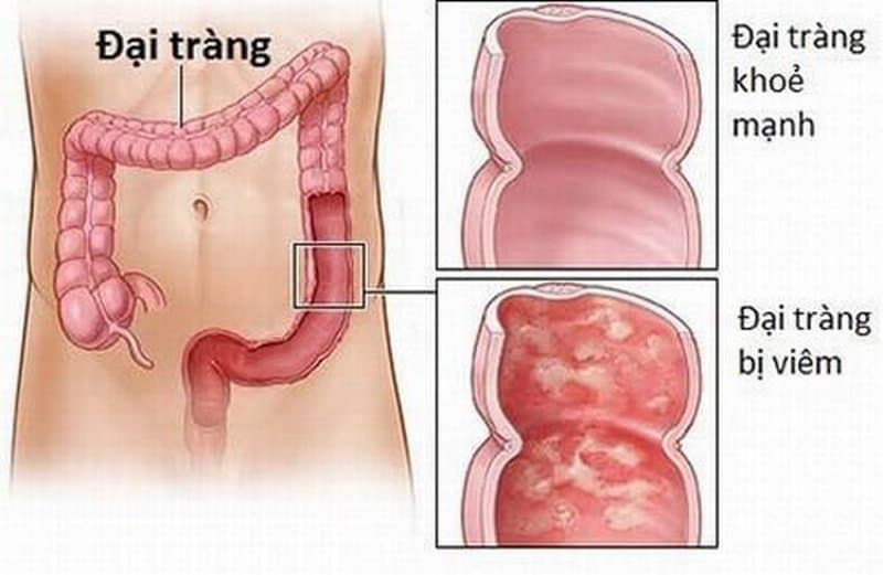 Viêm đại tràng co thắt mạn tính - nguyên nhân - triệu chứng và cách điều trị
