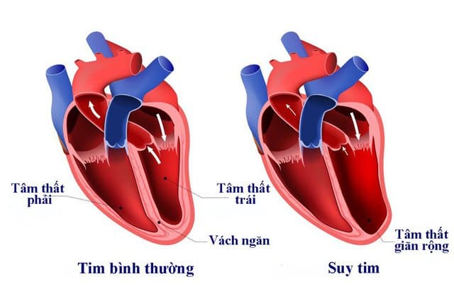 Suy tim - Nguyên nhân và Phương pháp điều trị hiệu quả