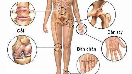 Đau đầu gối là bệnh gì? có phải là thoái hóa khớp gối không?