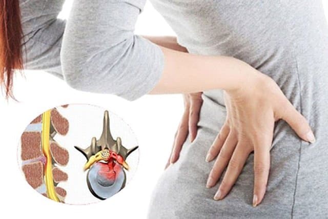 Chèn ép rễ thần kinh do thoát vị đĩa đệm lưng: Nguyên nhân - Biến chứng - Dấu hiệu