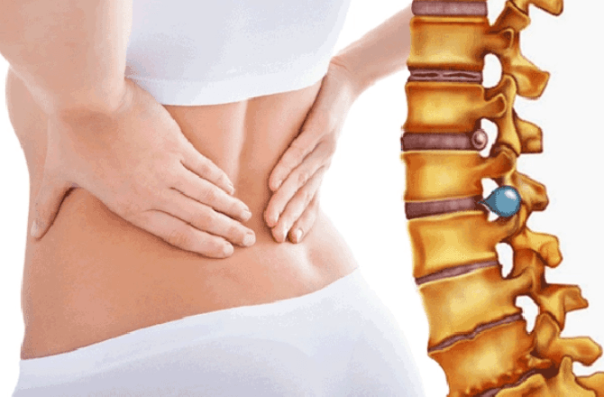 Thoát vị đĩa đệm tái phát sau phẫu thuật nội soi và cách chăm sóc