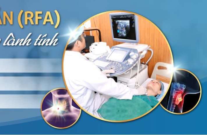 Đốt sóng cao tần (RFA) điều trị u tuyến giáp lành tính với chi phí hợp lý