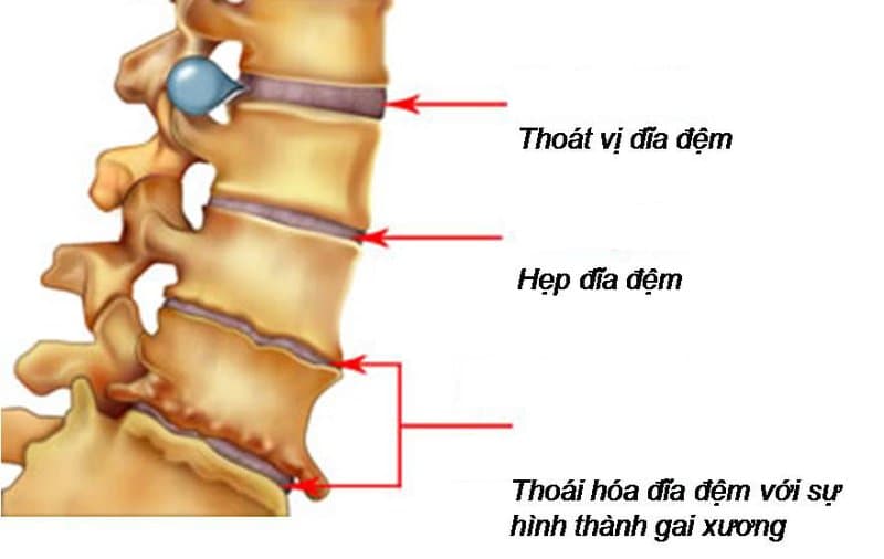 Chụp cộng hưởng từ MRI chẩn đoán thoát vị cột sống