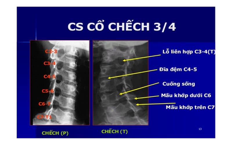 Chụp X quang cột sống cổ chếch 3⁄4 để chẩn đoán bênh cột sống