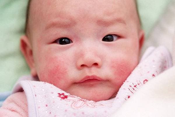 Hướng dẫn cách dưỡng ẩm da cho trẻ bị viêm da cơ địa