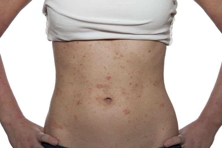 Những điều cần biết về bệnh viêm da cơ địa