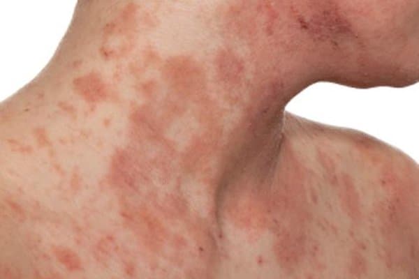 Viêm da cơ địa mùa hanh khô - phòng tránh và chăm sóc