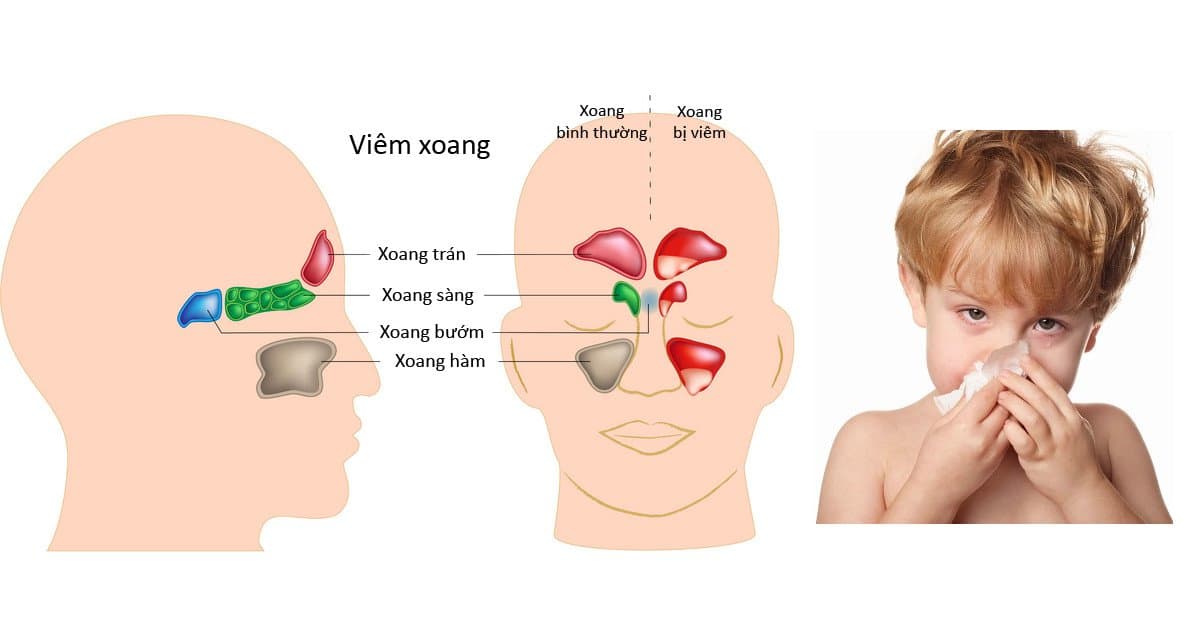 Biến chứng nguy hiểm do viêm xoang ở trẻ em và cách phòng tránh