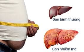 Dấu hiện nhận biết bệnh gan nhiễm mỡ qua 3 giai đoạn