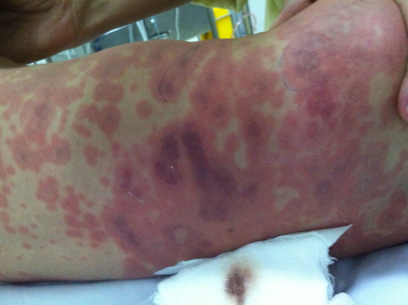 Viêm màng não mô cầu là bệnh gì? Nguyên nhân, dấu hiệu, cách phòng tránh