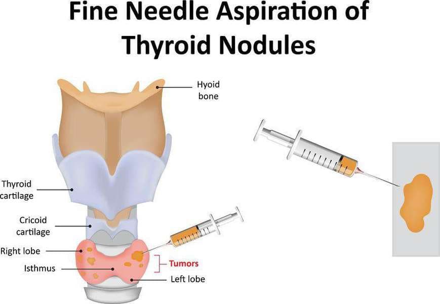 Sinh thiết tuyến giáp là gì?, khi nào cần và ý nghĩa