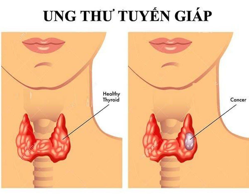 Phẫu thuật cắt toàn bộ tuyến giáp trong điều trị ung thư và tai biến có thể xảy ra