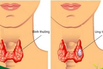 Những phương pháp điều trị Ung thư tuyến giáp hiện nay