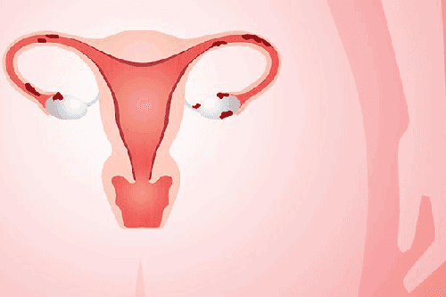 Lạc nội mạc tử cung và thụ tinh trong ống nghiệm IVF điều trị vô sinh