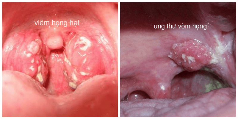 Phân biệt viêm họng thông thường và ung thư vòm họng