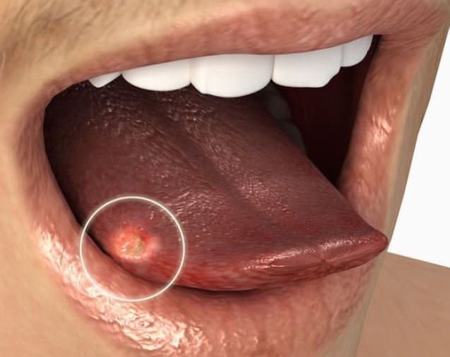 Những đối tượng nên tầm soát sàng lọc ung thư lưỡi?