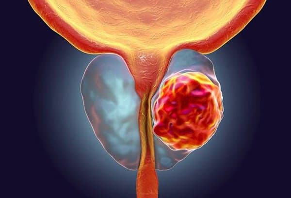Thuốc trị ung thư vú và buồng trứng trong ung thư tuyến tiền liệt giai đoạn muộn