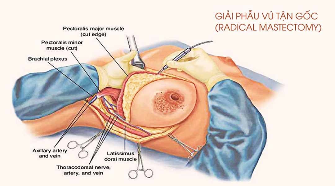 Tìm hiểu về phẫu thuật cắt bỏ vú điều trị nang tuyến vú