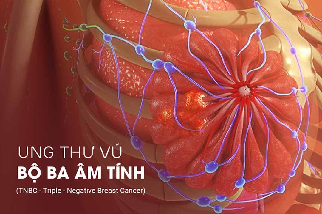 Ung thư vú bộ ba âm tính và những thông tin cần nắm rõ