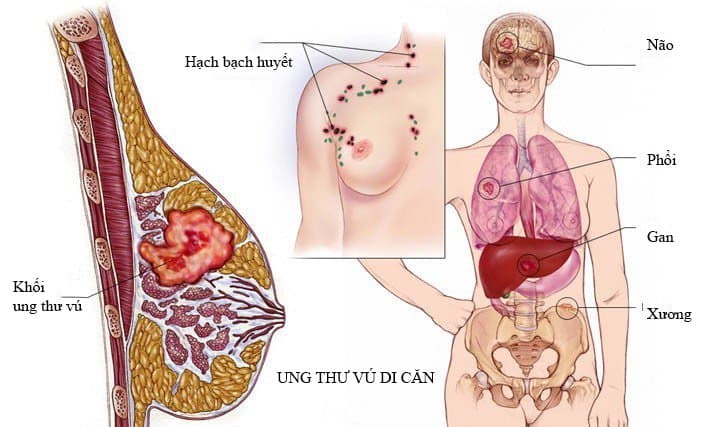 Ung thư vú di căn: Dấu hiệu, chẩn đoán và cách điều trị