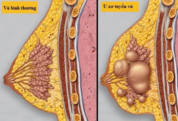 U xơ tuyến vú có khả năng tiến triển thành ung thư vú không?