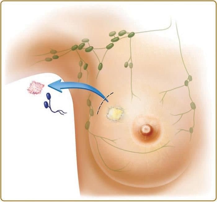 Điều trị bảo tồn tuyến vú cho bệnh nhân ung thư vú