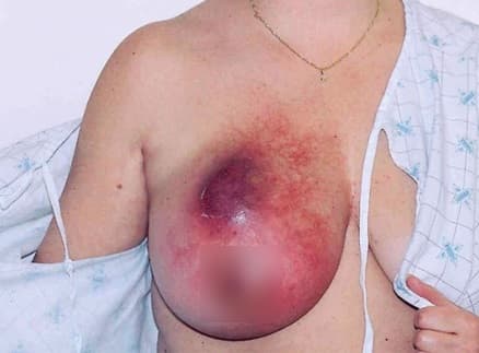 Thông tin có ích cho bệnh nhân ung thư vú và ung thư phổi