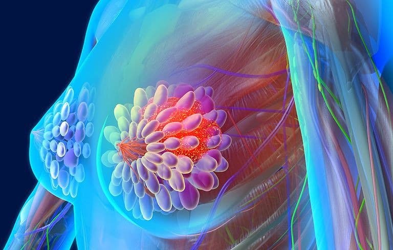 Yếu tố giúp thay đổi nguy cơ mắc ung thư vú ở phụ nữ