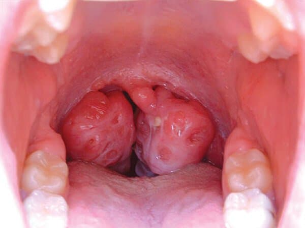 Những hình ảnh về bệnh ung thư vòm họng