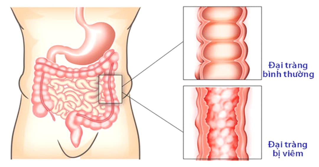 Danh sách những bác sĩ chuyên gia điều trị bệnh đại tràng hàng đầu tại Hà Nội