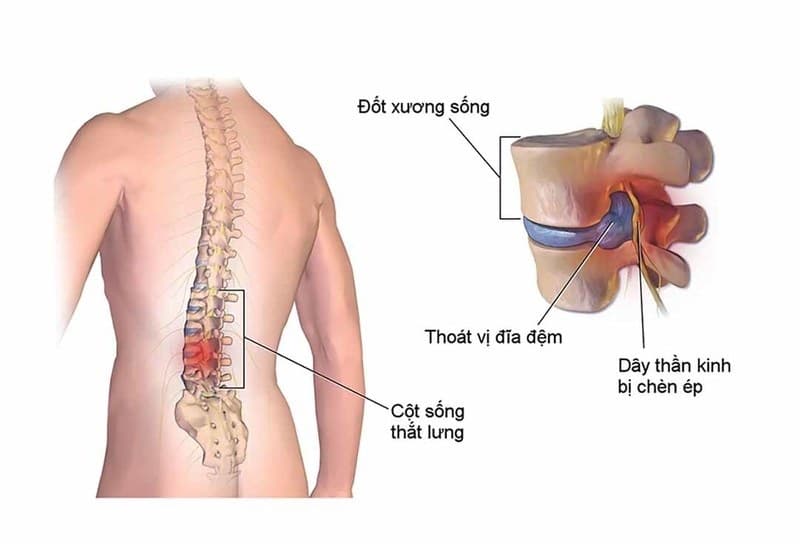 4 cơ sở y tế hàng đầu tại Hà Nội chuyên điều trị đau thắt lưng