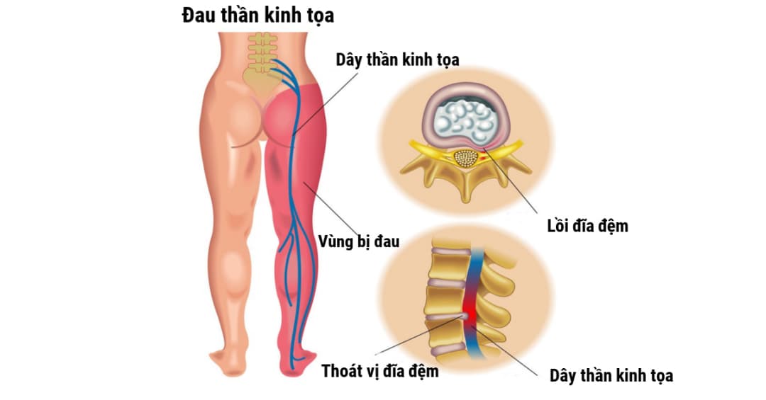 Các phương pháp điều trị đau thần kinh tọa hiệu quả và địa chỉ uy tín