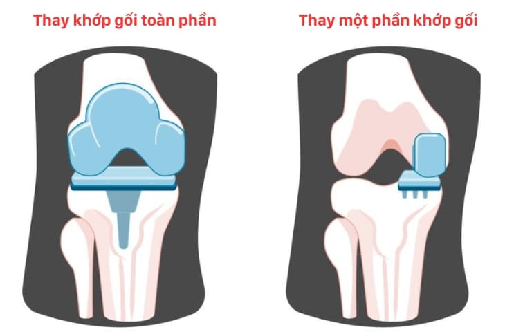 Top 5 Địa Chỉ Thay Khớp Gối Đáng Tin Cậy Tại TP.HCM