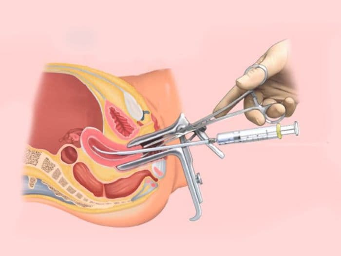 Top 6 Địa Chỉ IUI Uy Tín Tại TPHCM Với Tỷ Lệ Thành Công Cao