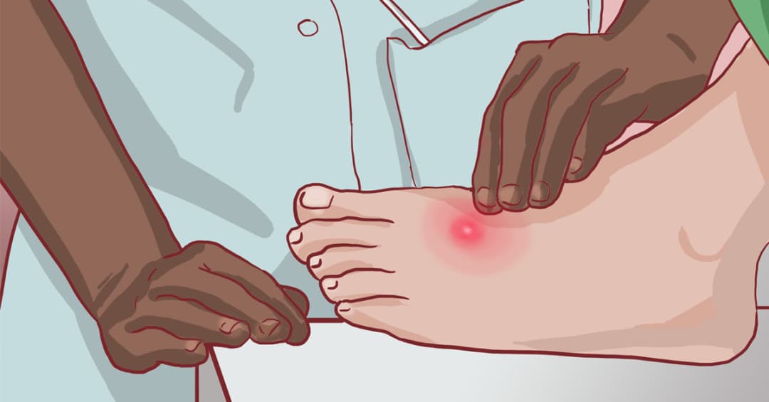 Chích mụn nhọt có phải là giải pháp hiệu quả? Địa chỉ chích nhọt uy tín tại TP.HCM