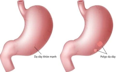 Cắt Polyp Dạ Dày: Có Nguy Hiểm Không?