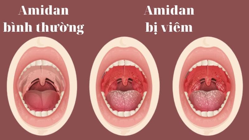 6 Bác sĩ chuyên điều trị viêm amidan hàng đầu tại TP.HCM
