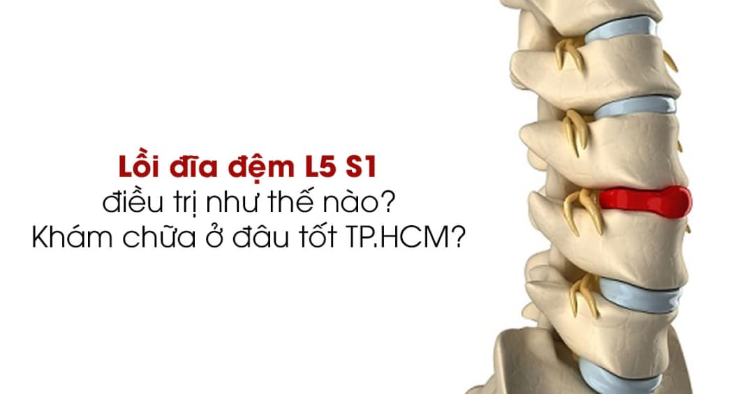 Cách điều trị lồi đĩa đệm L5 S1 và địa chỉ khám chữa uy tín tại TP.HCM