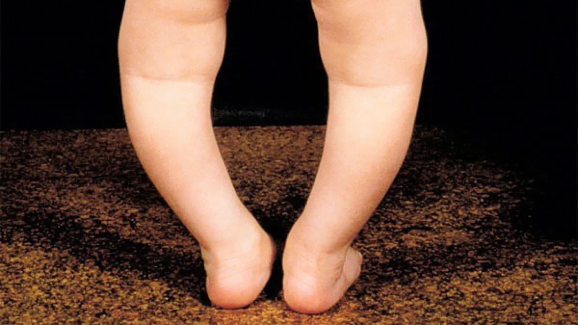 Địa chỉ uy tín khám và điều trị chân vòng kiềng cho trẻ