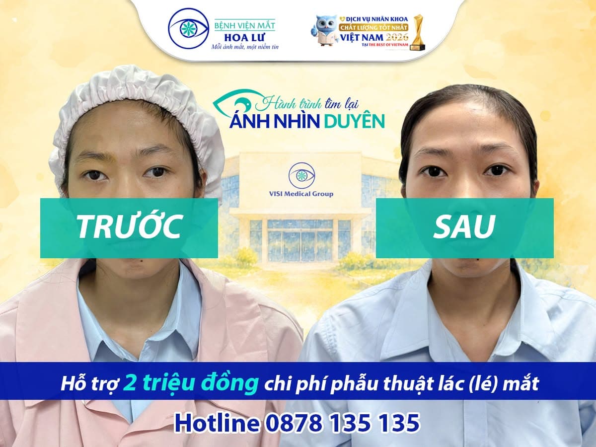 “Mắt em thỉnh thoảng mới lệch, nên trước đây em cũng không nghĩ nhiều…”- Cô gái 24 tuổi quyết định tìm lại ánh nhìn tự tin