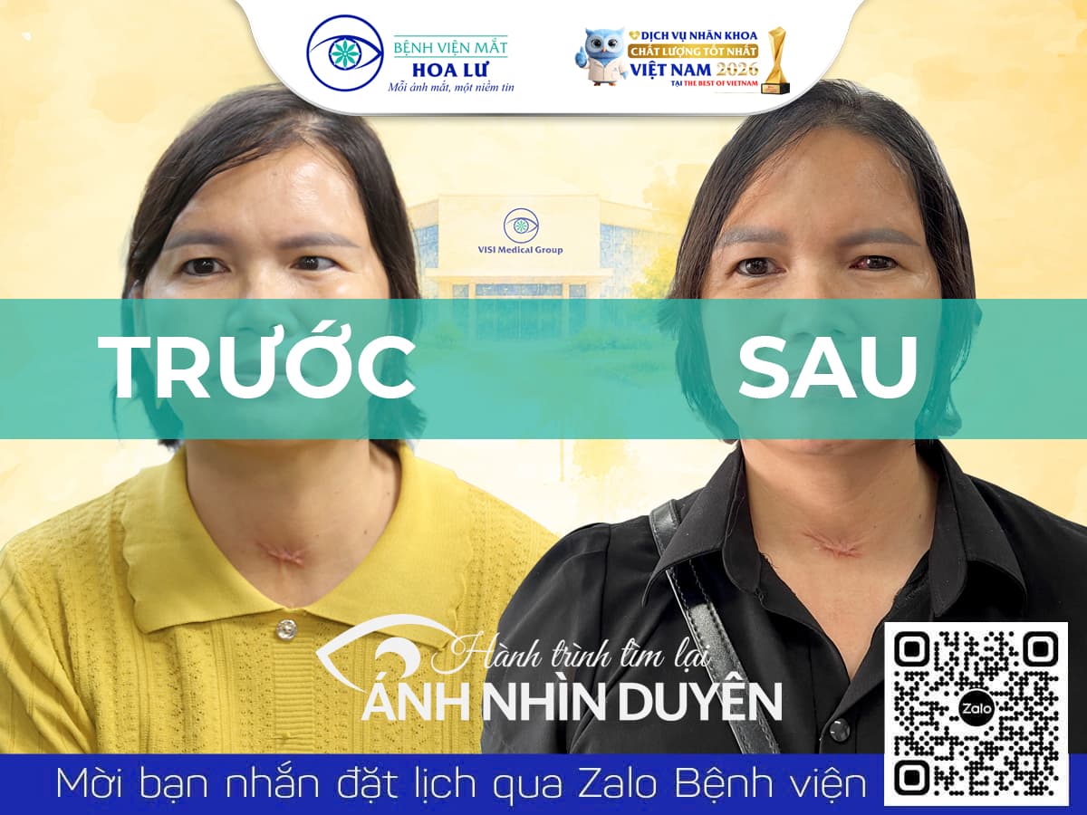 Phẫu thuật lác - điều chị Mầu chờ đợi sau 2 năm kể từ tai nạn