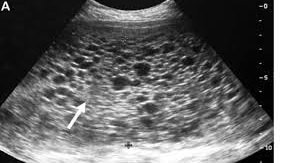 Những dấu hiệu nhận biết Chửa trứng hay tình trạng thai nghén bất thường - ảnh 2