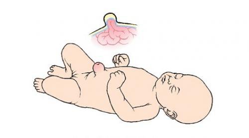 Thoát vị rốn ở trẻ sơ sinh: Nguyên nhân, dấu hiệu, biến chứng và điều trị - ảnh 1