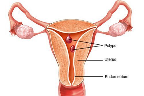 polyp cổ tử cung: Nguyên nhân, dấu hiệu nhận biết và cách điều trị - ảnh 1